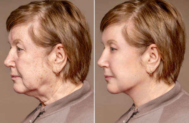 rhinoplastie à Lyon