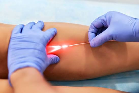 Laser varices